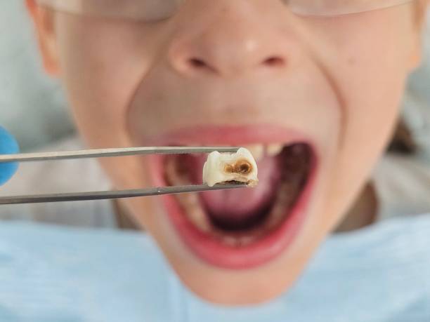 Best Emergency Wisdom Teeth Removal in Warrensburg, MO
